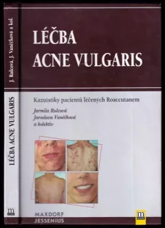 Léčba acne vulgaris